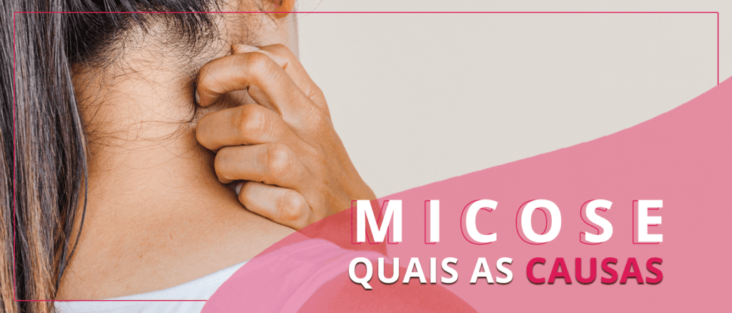 Micose - O Que é E Como Identificar Cada Uma? - Centro De Dermatologia